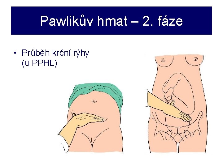 Pawlikův hmat – 2. fáze • Průběh krční rýhy (u PPHL) 