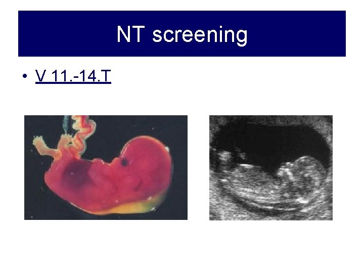 NT screening • V 11. -14. T 