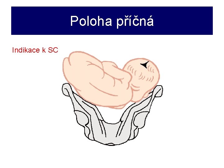 Poloha příčná Indikace k SC 