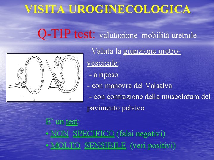 VISITA UROGINECOLOGICA Q-TIP test: valutazione mobilità uretrale Valuta la giunzione uretrovescicale: - a riposo