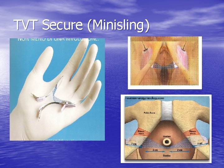 TVT Secure (Minisling) 