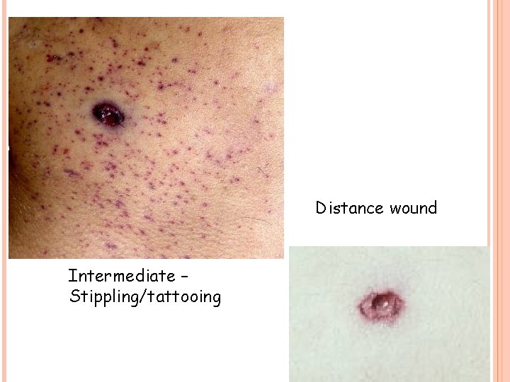 Distance wound Intermediate – Stippling/tattooing 11 