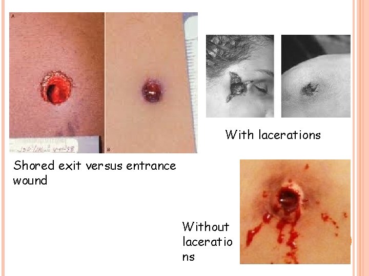 With lacerations Shored exit versus entrance wound Without laceratio ns 13 