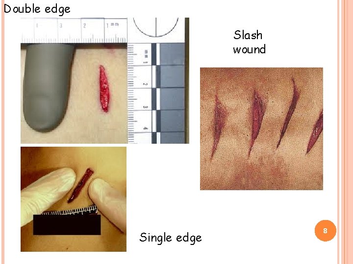 Double edge Slash wound Single edge 8 