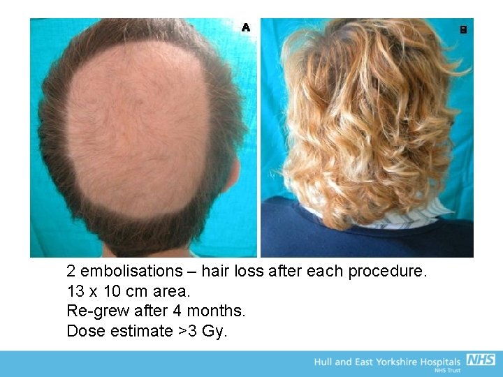 2 embolisations – hair loss after each procedure. 13 x 10 cm area. Re-grew