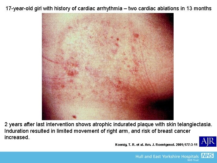 17 -year-old girl with history of cardiac arrhythmia – two cardiac ablations in 13