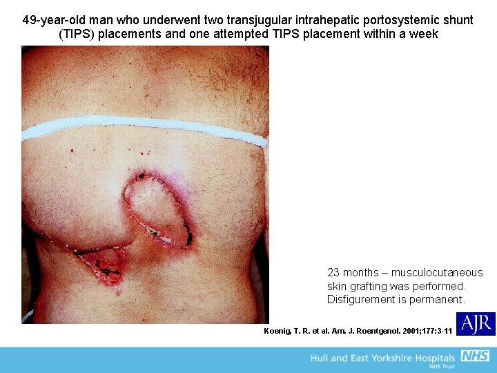49 -year-old man who underwent two transjugular intrahepatic portosystemic shunt (TIPS) placements and one