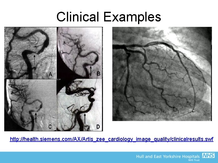 Clinical Examples http: //health. siemens. com/AX/Artis_zee_cardiology_image_quality/clinicalresults. swf 