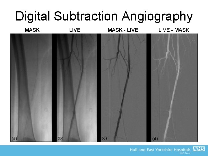 Digital Subtraction Angiography MASK LIVE MASK - LIVE - MASK 