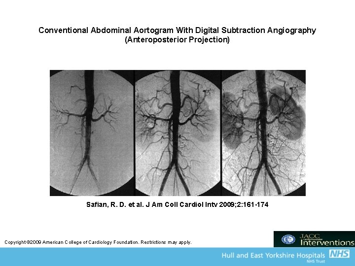Conventional Abdominal Aortogram With Digital Subtraction Angiography (Anteroposterior Projection) Safian, R. D. et al.