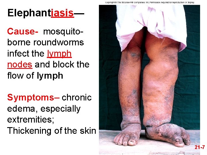 Elephantiasis— Cause- mosquitoborne roundworms infect the lymph nodes and block the flow of lymph
