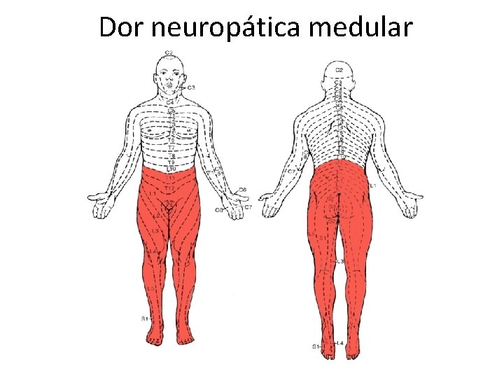 Dor neuropática medular Dor neuropática medular