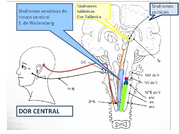 Síndromes sensitivas do tronco cerebral S. de Wallemberg DOR CENTRAL Síndromes talâmicas Dor Talâmica Síndromes sensitivas do tronco cerebral S. de Wallemberg DOR CENTRAL Síndromes talâmicas Dor Talâmica
