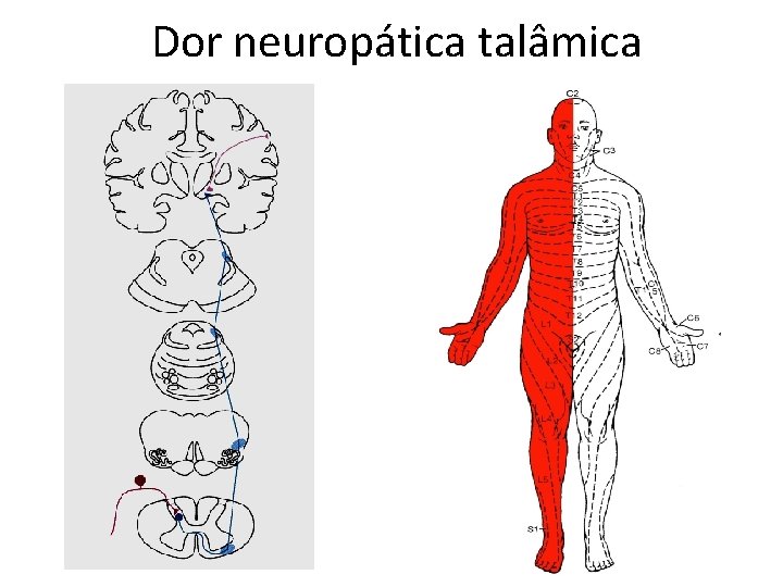 Dor neuropática talâmica Dor neuropática talâmica