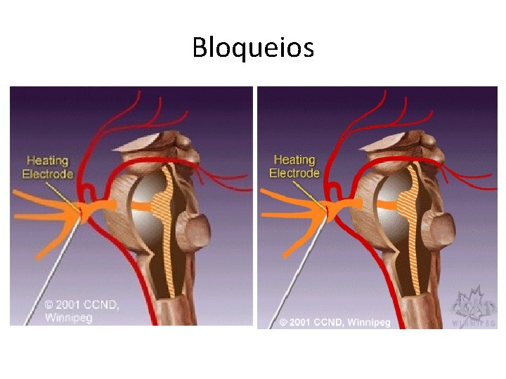 Bloqueios Bloqueios