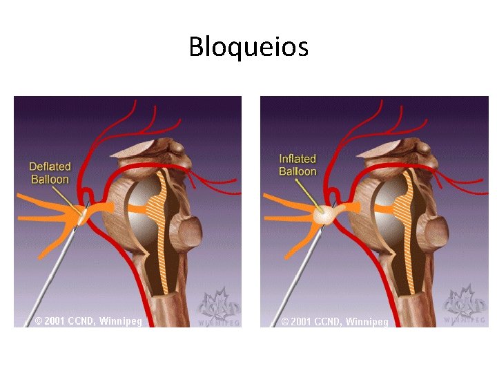 Bloqueios Bloqueios