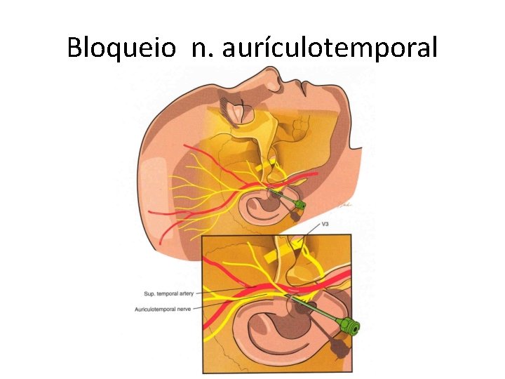 Bloqueio n. aurículotemporal Bloqueio n. aurículotemporal