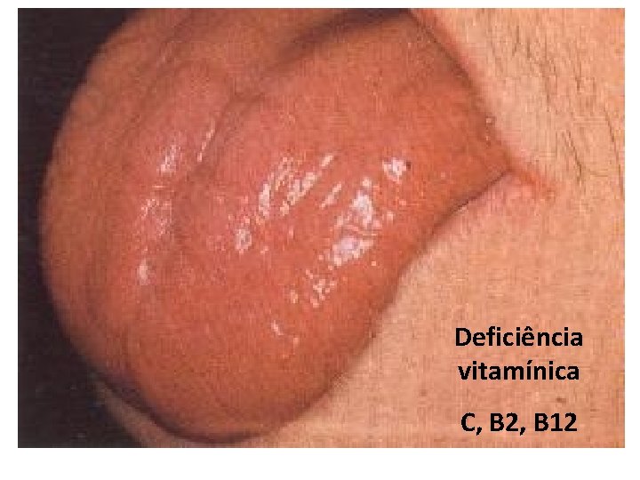 Deficiência vitamínica C, B 2, B 12 Deficiência vitamínica C, B 2, B 12
