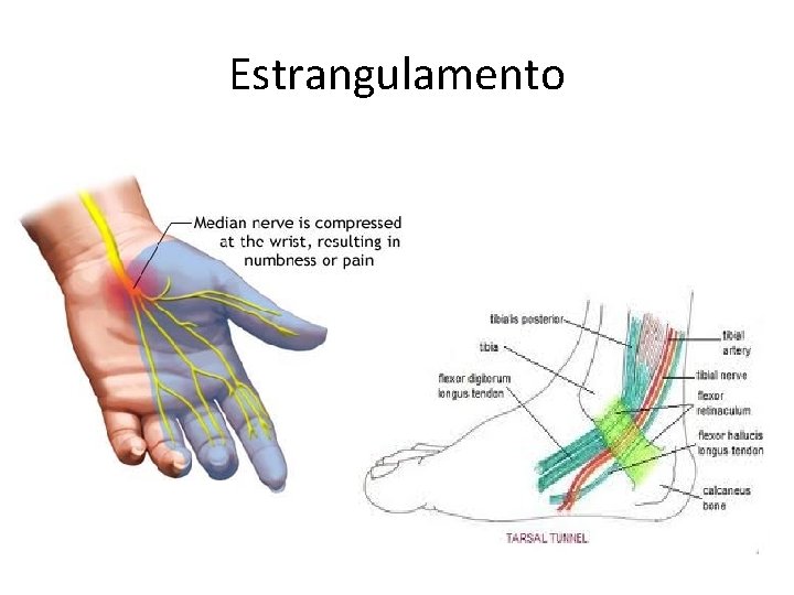 Estrangulamento Estrangulamento