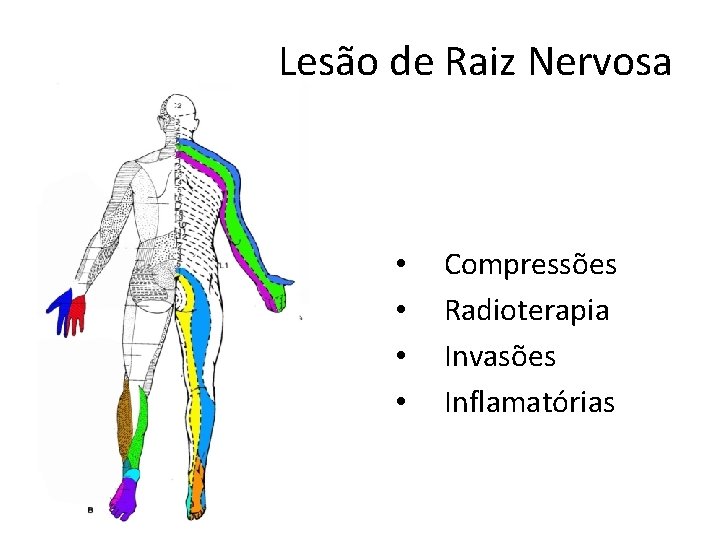 Lesão de Raiz Nervosa • • Compressões Radioterapia Invasões Inflamatórias Lesão de Raiz Nervosa • • Compressões Radioterapia Invasões Inflamatórias