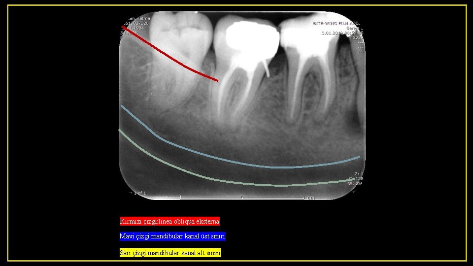 Kırmızı çizgi: linea obliqua eksterna Mavi çizgi: mandibular kanal üst sınırı Sarı çizgi: mandibular