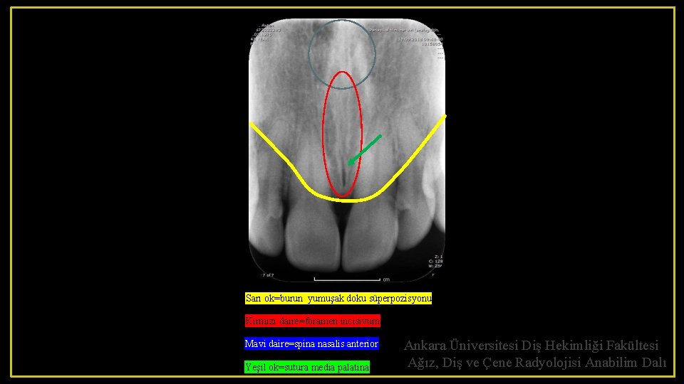 Sarı ok=burun yumuşak doku süperpozisyonu Kırmızı daire=foramen incisivum Mavi daire=spina nasalis anterior Yeşil ok=sutura