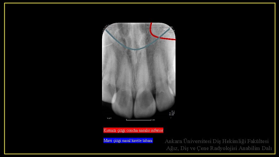 Kırmızı çizgi: concha nasalis inferior Mavi çizgi: nasal kavite tabanı Ankara Üniversitesi Diş Hekimliği