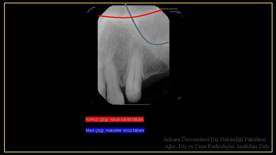 Kırmızı çizgi: nasal kavite tabanı Mavi çizgi : maksiller sinüs tabanı Ankara Üniversitesi Diş