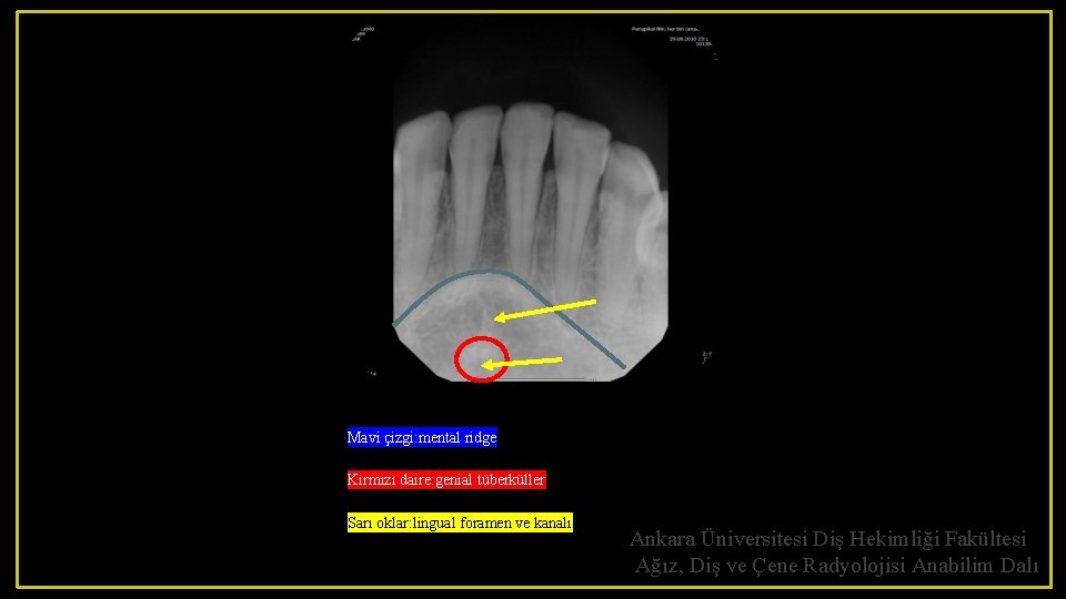 Mavi çizgi: mental ridge Kırmızı daire: genial tüberküller Sarı oklar: lingual foramen ve kanalı
