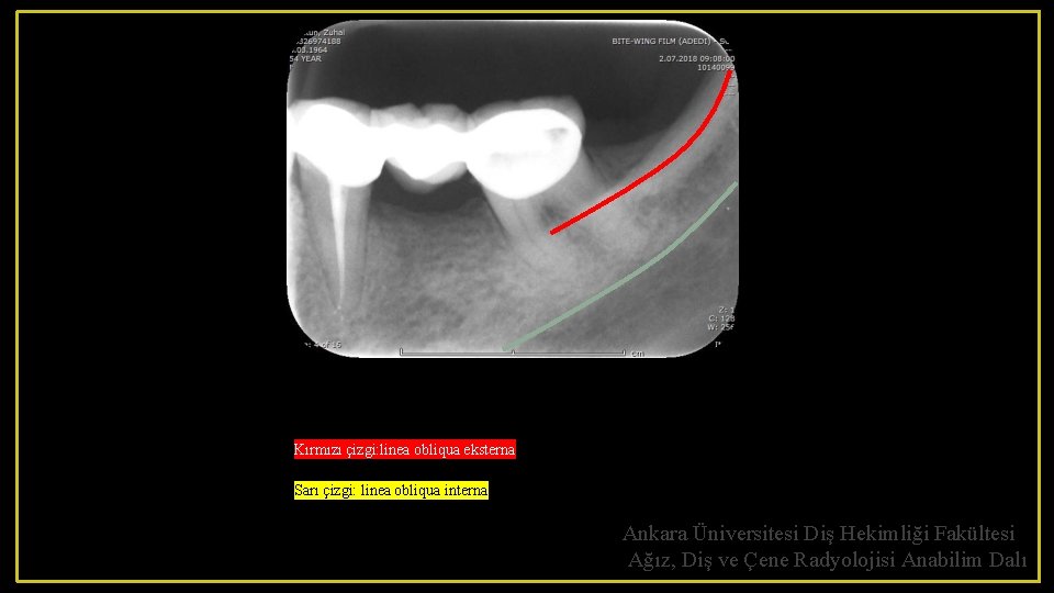 Kırmızı çizgi: linea obliqua eksterna Sarı çizgi: linea obliqua interna Ankara Üniversitesi Diş Hekimliği