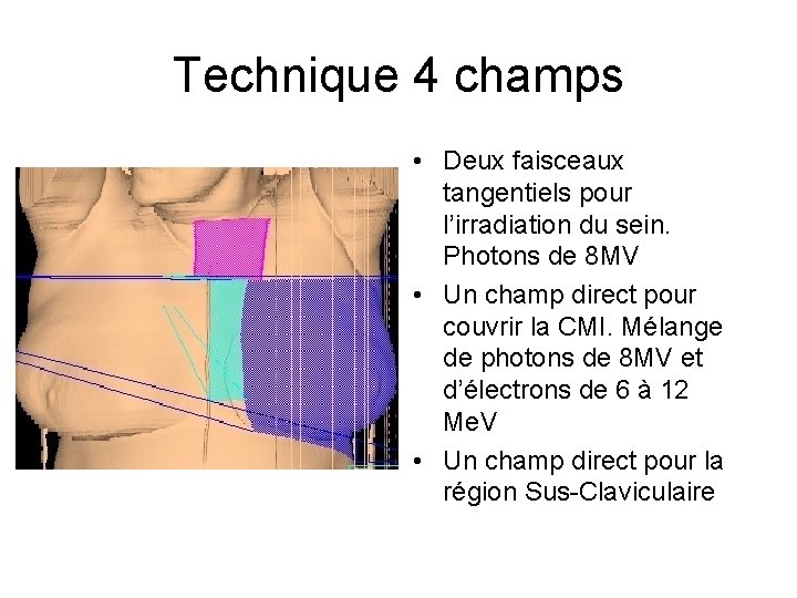 Technique 4 champs • Deux faisceaux tangentiels pour l’irradiation du sein. Photons de 8