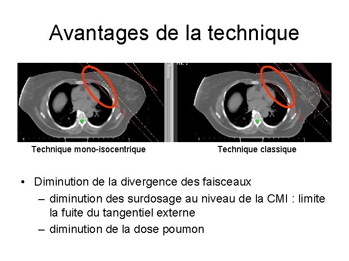 Avantages de la technique Technique mono-isocentrique Technique classique • Diminution de la divergence des