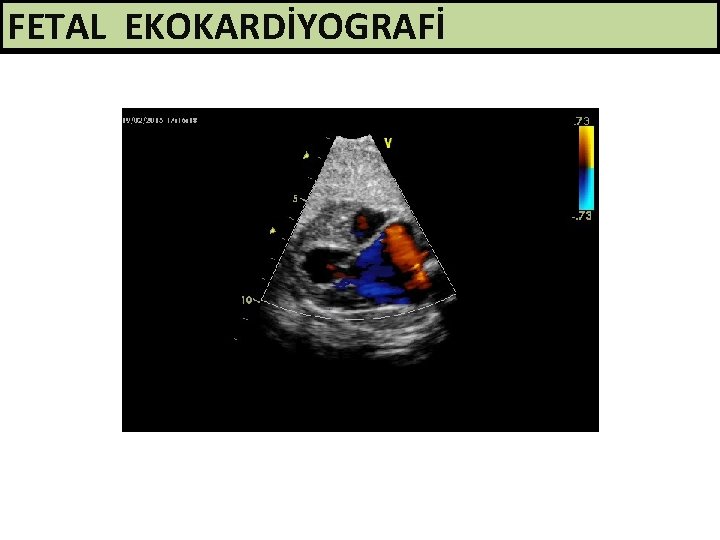 FETAL EKOKARDİYOGRAFİ 