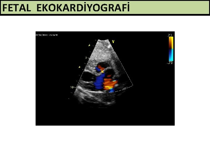 FETAL EKOKARDİYOGRAFİ 
