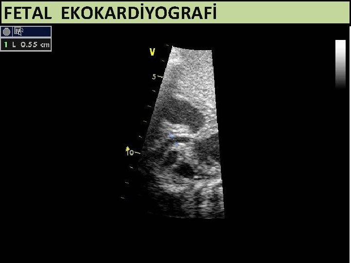 FETAL EKOKARDİYOGRAFİ 