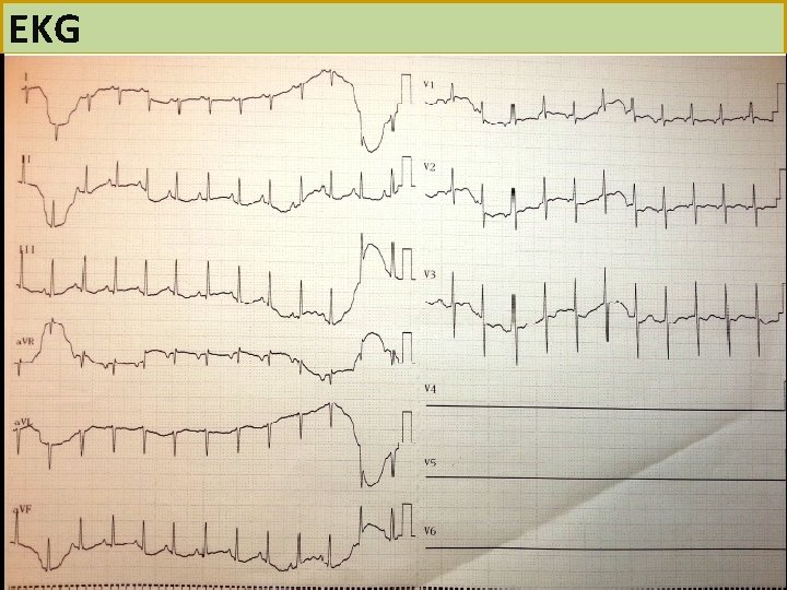 EKG 