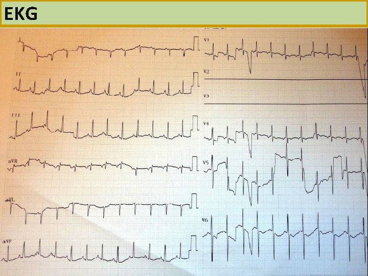 EKG 