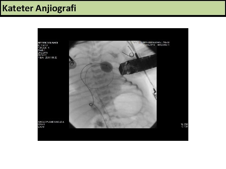 Kateter Anjiografi 