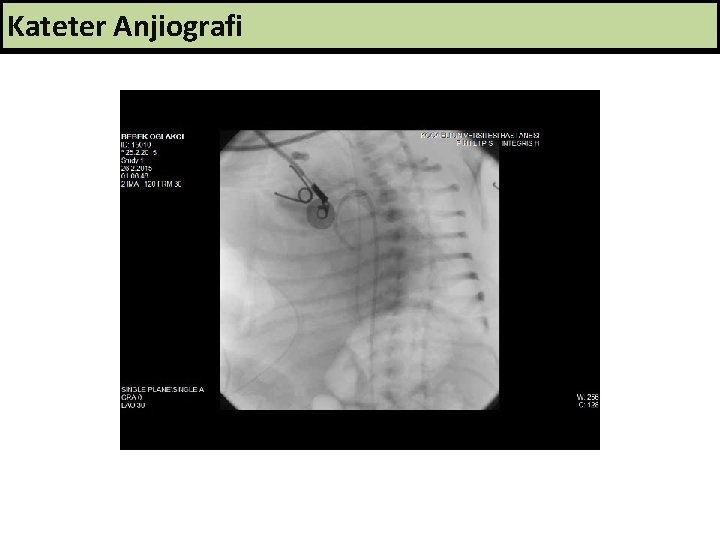 Kateter Anjiografi 