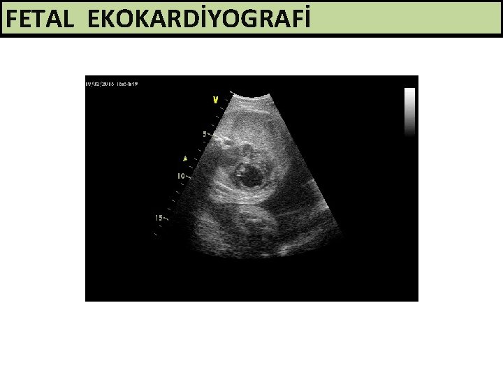 FETAL EKOKARDİYOGRAFİ 