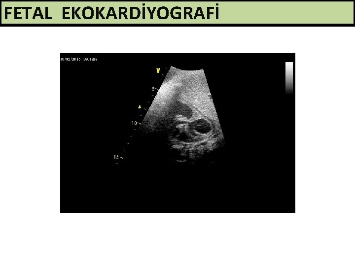 FETAL EKOKARDİYOGRAFİ 