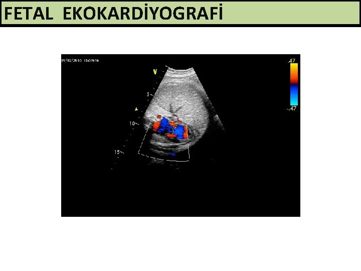 FETAL EKOKARDİYOGRAFİ 