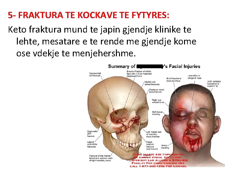 5 - FRAKTURA TE KOCKAVE TE FYTYRES: Keto fraktura mund te japin gjendje klinike 5 - FRAKTURA TE KOCKAVE TE FYTYRES: Keto fraktura mund te japin gjendje klinike
