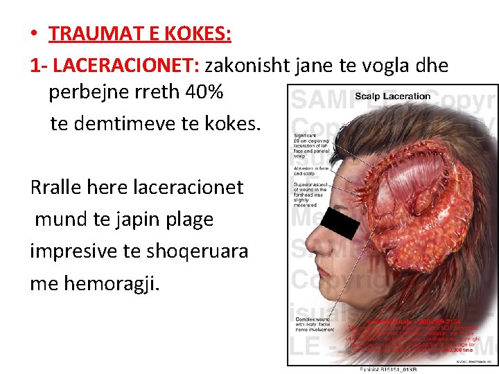 • TRAUMAT E KOKES: 1 - LACERACIONET: zakonisht jane te vogla dhe perbejne • TRAUMAT E KOKES: 1 - LACERACIONET: zakonisht jane te vogla dhe perbejne
