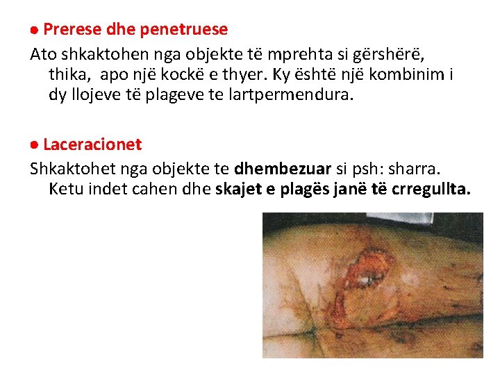 Prerese dhe penetruese Ato shkaktohen nga objekte të mprehta si gërshërë, thika, apo Prerese dhe penetruese Ato shkaktohen nga objekte të mprehta si gërshërë, thika, apo