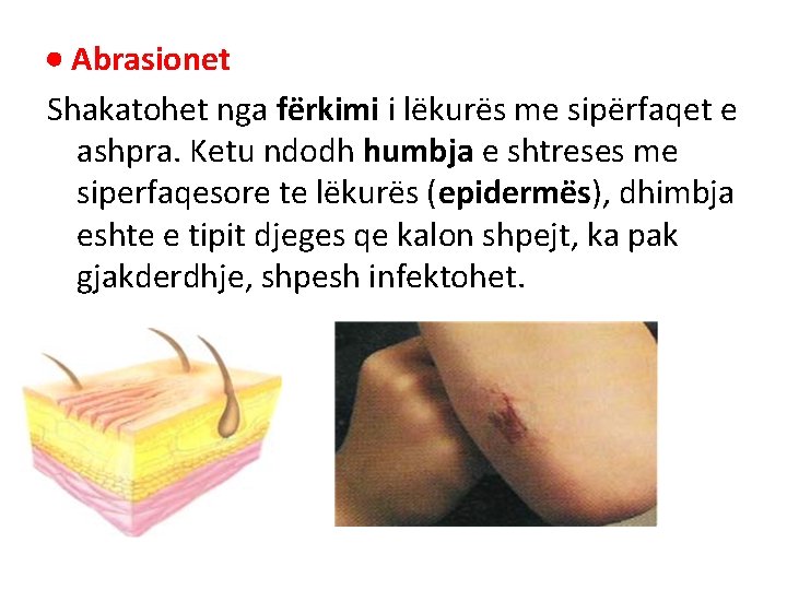 Abrasionet Shakatohet nga fërkimi i lëkurës me sipërfaqet e ashpra. Ketu ndodh humbja Abrasionet Shakatohet nga fërkimi i lëkurës me sipërfaqet e ashpra. Ketu ndodh humbja