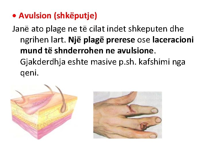 Avulsion (shkëputje) Janë ato plage ne të cilat indet shkeputen dhe ngrihen lart. Avulsion (shkëputje) Janë ato plage ne të cilat indet shkeputen dhe ngrihen lart.