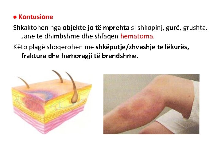Kontusione Shkaktohen nga objekte jo të mprehta si shkopinj, gurë, grushta. Jane te Kontusione Shkaktohen nga objekte jo të mprehta si shkopinj, gurë, grushta. Jane te