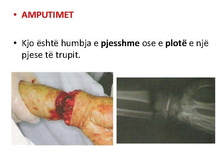 • AMPUTIMET • Kjo është humbja e pjesshme ose e plotë e një • AMPUTIMET • Kjo është humbja e pjesshme ose e plotë e një