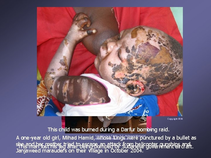 Copyright IRIN Courtesy Brian Steidle This child was burned during a Darfur bombing raid.